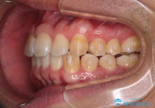 【インビザライン】目立たない矯正で前歯を綺麗にの治療中