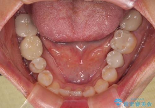 新幹線通院 地元で断られた奥歯のむし歯治療の治療前