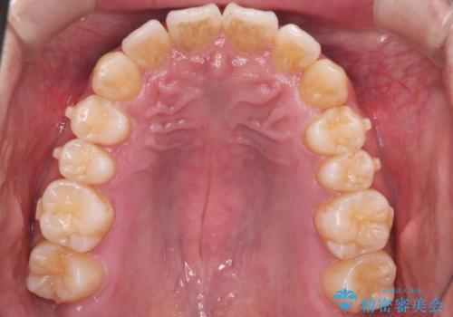【インビザライン】目立たない矯正で前歯を綺麗にの治療中