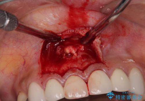 新幹線通院 地元で断られた奥歯のむし歯治療の治療中