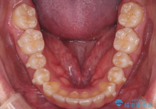 【インビザライン】目立たない矯正で前歯を綺麗にの治療中