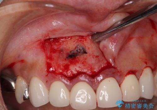新幹線通院 地元で断られた奥歯のむし歯治療の治療後