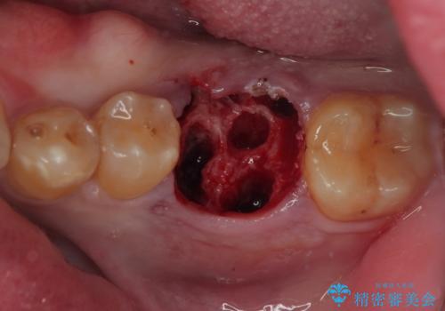咬合力で破折した奥歯 抜歯即時埋入インプラントによる補綴治療の治療中