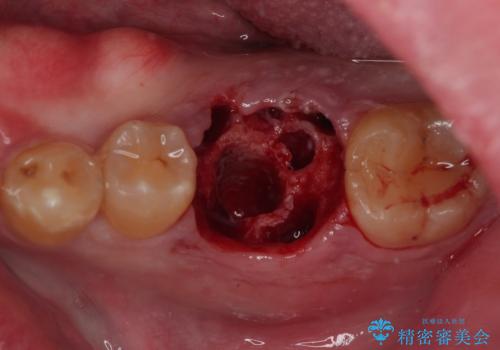 咬合力で破折した奥歯 抜歯即時埋入インプラントによる補綴治療の治療後