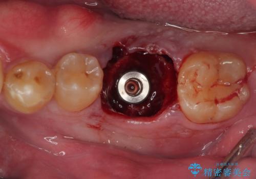 咬合力で破折した奥歯 抜歯即時埋入インプラントによる補綴治療の治療前