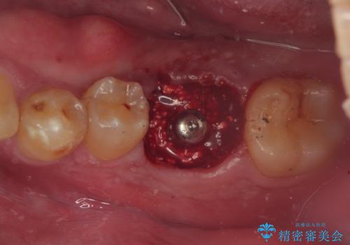 咬合力で破折した奥歯　抜歯即時埋入インプラントによる補綴治療の治療中