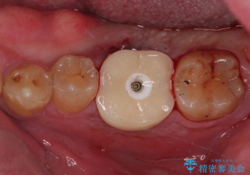 咬合力で破折した奥歯 抜歯即時埋入インプラントによる補綴治療の治療中