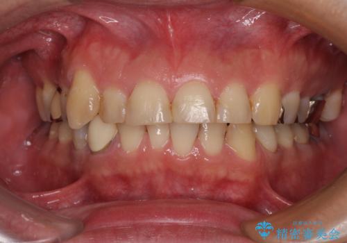 銀歯を白くしたい 一緒に矯正治療も行ない美しい口腔内にの症例 治療前