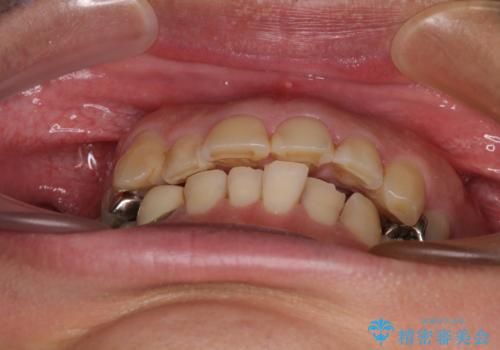 銀歯を白くしたい 一緒に矯正治療も行ない美しい口腔内にの治療前