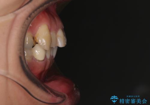銀歯を白くしたい 一緒に矯正治療も行ない美しい口腔内にの治療前