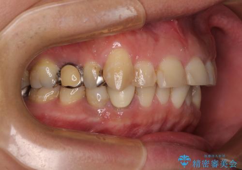 銀歯を白くしたい　一緒に矯正治療も行ない美しい口腔内にの治療前