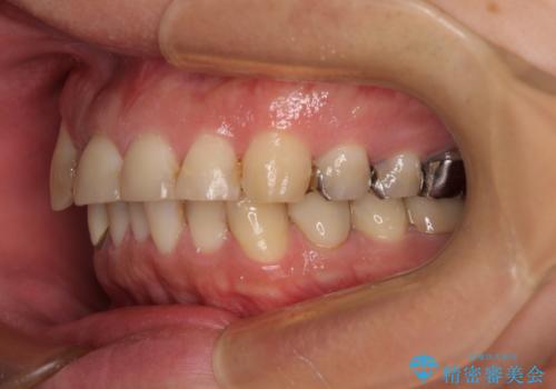 銀歯を白くしたい 一緒に矯正治療も行ない美しい口腔内にの治療前