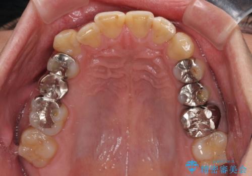 銀歯を白くしたい 一緒に矯正治療も行ない美しい口腔内にの治療前