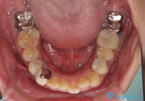 銀歯を白くしたい 一緒に矯正治療も行ない美しい口腔内にの治療前
