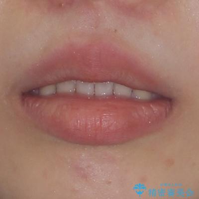 前歯のオープンバイト インビザラインで咬み合わせを改善の治療前(顔貌)