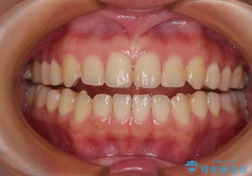 前歯のオープンバイト インビザラインで咬み合わせを改善の症例 治療前