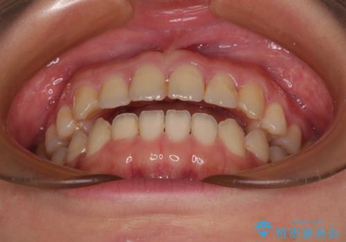 前歯のオープンバイト インビザラインで咬み合わせを改善の治療前