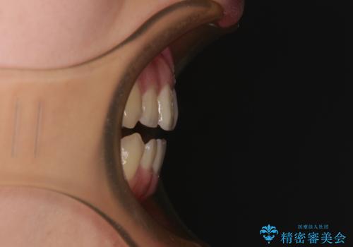 前歯のオープンバイト インビザラインで咬み合わせを改善の治療前