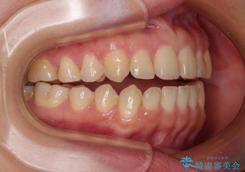 前歯のオープンバイト インビザラインで咬み合わせを改善の治療前