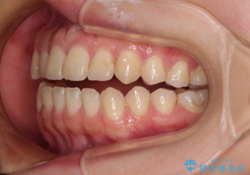 前歯のオープンバイト インビザラインで咬み合わせを改善の治療前