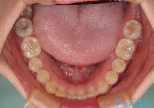 前歯のオープンバイト インビザラインで咬み合わせを改善の治療前