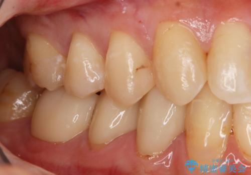 劣化したプラスチックをセラミックへ!の治療前