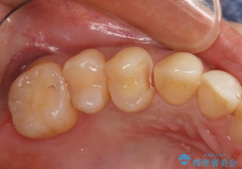 劣化したプラスチックをセラミックへ!の治療中