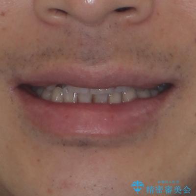 インビザラインは煩わしい ワイヤー矯正で短期間矯正治療の治療前(顔貌)