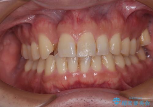 インビザラインは煩わしい ワイヤー矯正で短期間矯正治療の症例 治療前