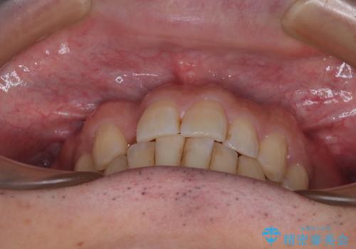 インビザラインは煩わしい ワイヤー矯正で短期間矯正治療の治療前