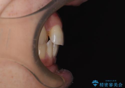 インビザラインは煩わしい ワイヤー矯正で短期間矯正治療の治療前