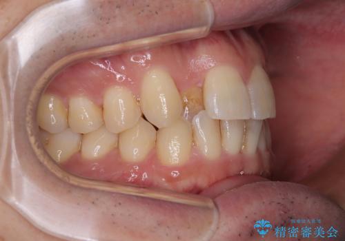 インビザラインは煩わしい ワイヤー矯正で短期間矯正治療の治療前