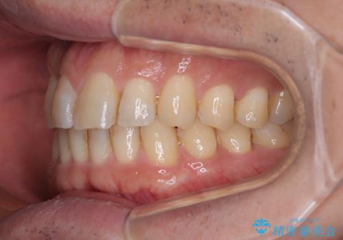 インビザラインは煩わしい ワイヤー矯正で短期間矯正治療の治療前