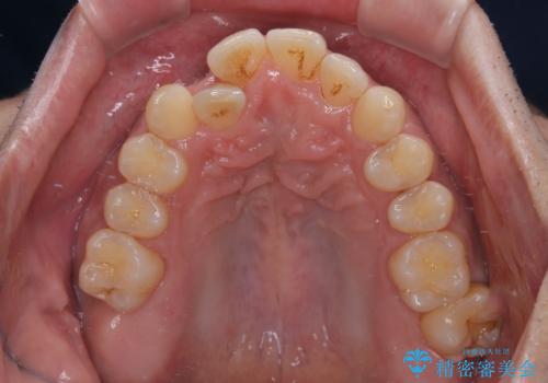インビザラインは煩わしい ワイヤー矯正で短期間矯正治療の治療前