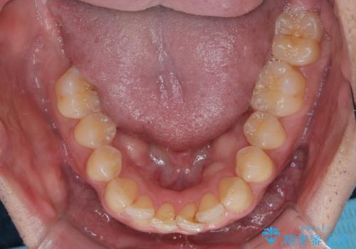 インビザラインは煩わしい ワイヤー矯正で短期間矯正治療の治療前
