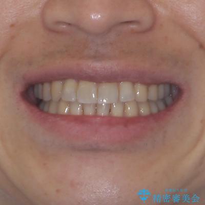 インビザラインは煩わしい ワイヤー矯正で短期間矯正治療の治療後(顔貌)