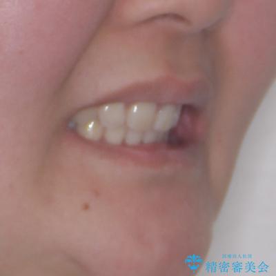 飛び出した口元を改善したい ワイヤー装置による抜歯矯正治療の治療後(顔貌)