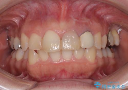 変色してきた歯とプラスチックのクラウン オールセラミッククラウン治療の治療前