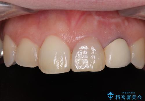 変色してきた歯とプラスチックのクラウン オールセラミッククラウン治療の症例 治療前