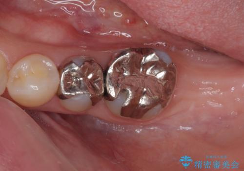 奥歯に歯を入れたい 即時荷重インプラントによる短期間インプラント治療の症例 治療前