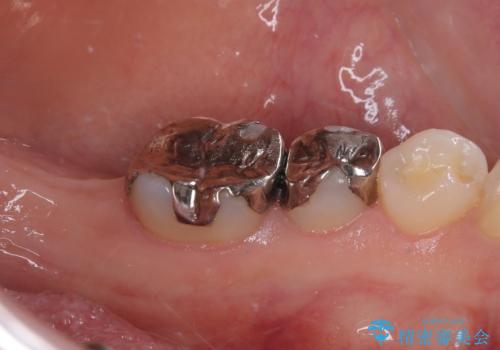 奥歯に歯を入れたい 即時荷重インプラントによる短期間インプラント治療の治療前