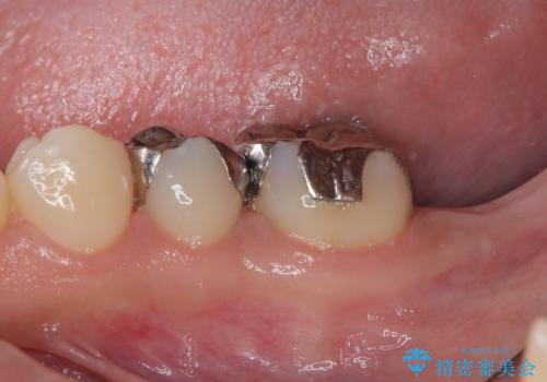 奥歯に歯を入れたい 即時荷重インプラントによる短期間インプラント治療の治療前