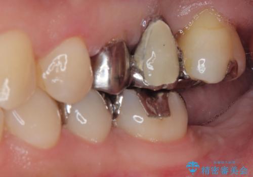 奥歯に歯を入れたい 即時荷重インプラントによる短期間インプラント治療の治療前