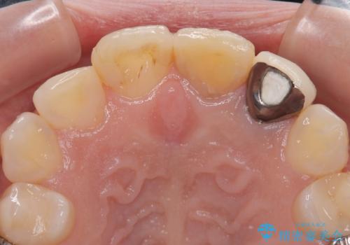 変色してきた歯とプラスチックのクラウン オールセラミッククラウン治療の治療前