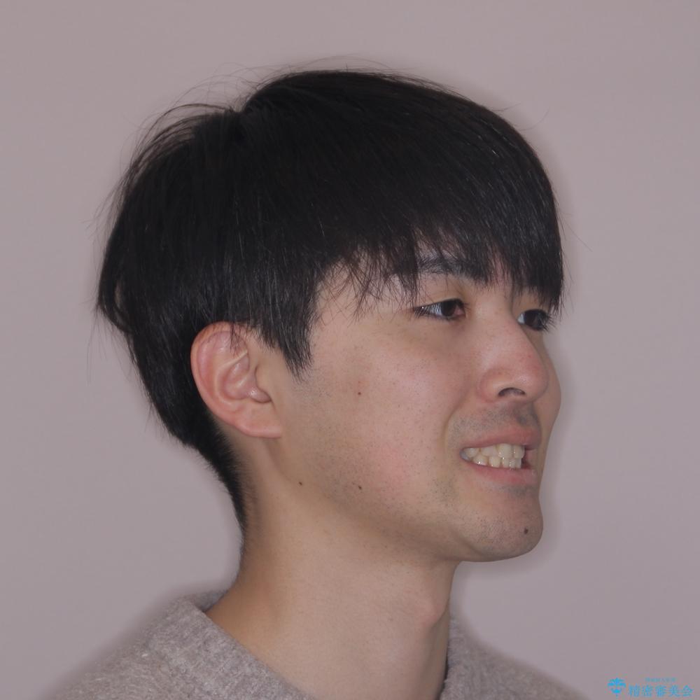 【モニター】出っ歯と奥歯の咬み合わせを改善 補助装置を用いたワイヤー抜歯矯正の治療後(顔貌)