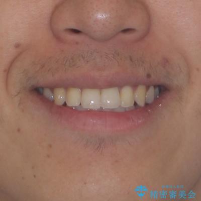 気になる前歯のデコボコと八重歯 ワイヤー矯正ですっきりとの治療後(顔貌)