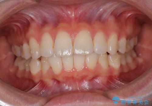 深い咬み合わせによる隙間 インビザライン矯正でコンプレックスを改善の治療中