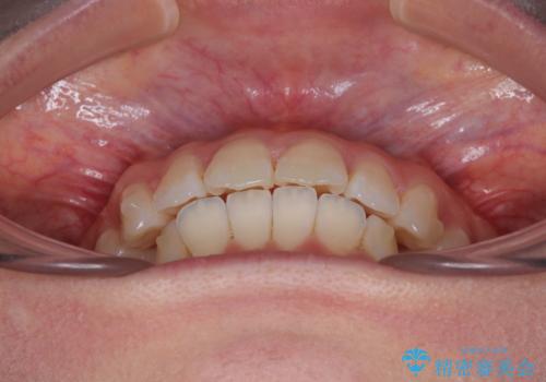 深い咬み合わせによる隙間 インビザライン矯正でコンプレックスを改善の治療中