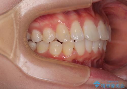 深い咬み合わせによる隙間 インビザライン矯正でコンプレックスを改善の治療中