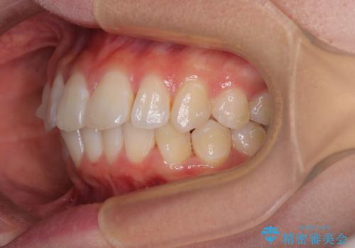 深い咬み合わせによる隙間 インビザライン矯正でコンプレックスを改善の治療中